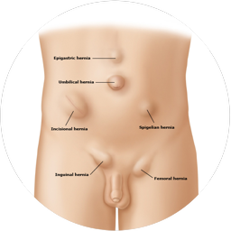 ULTRASONIDO DE PARED ABDOMINAL